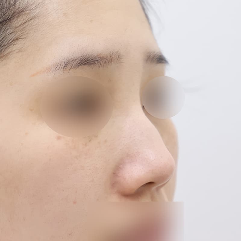 코재수술 수술 전