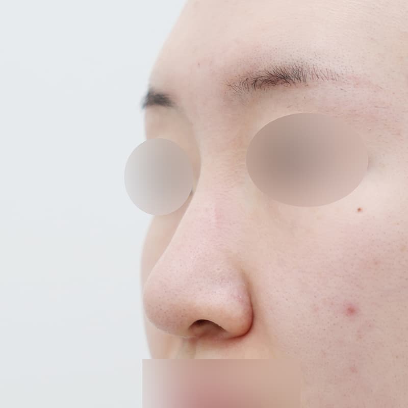코재수술 수술 전