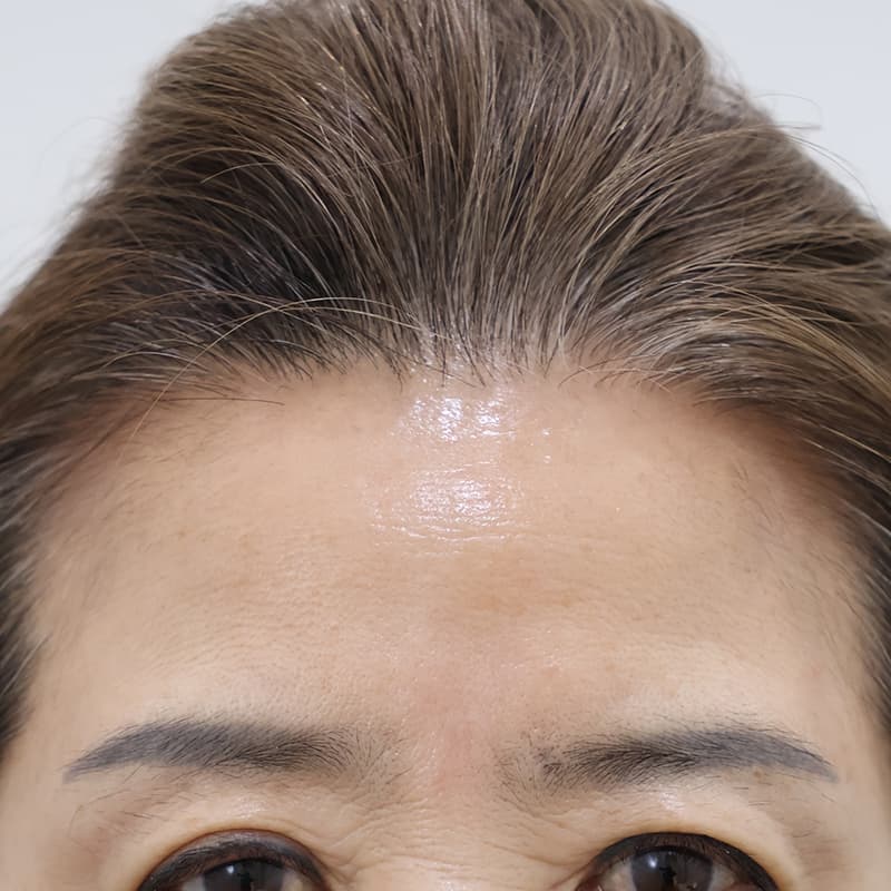 내시경 이마거상 before