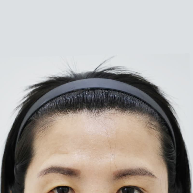 이마축소 before