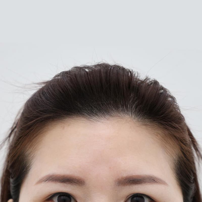 내시경 이마거상 before