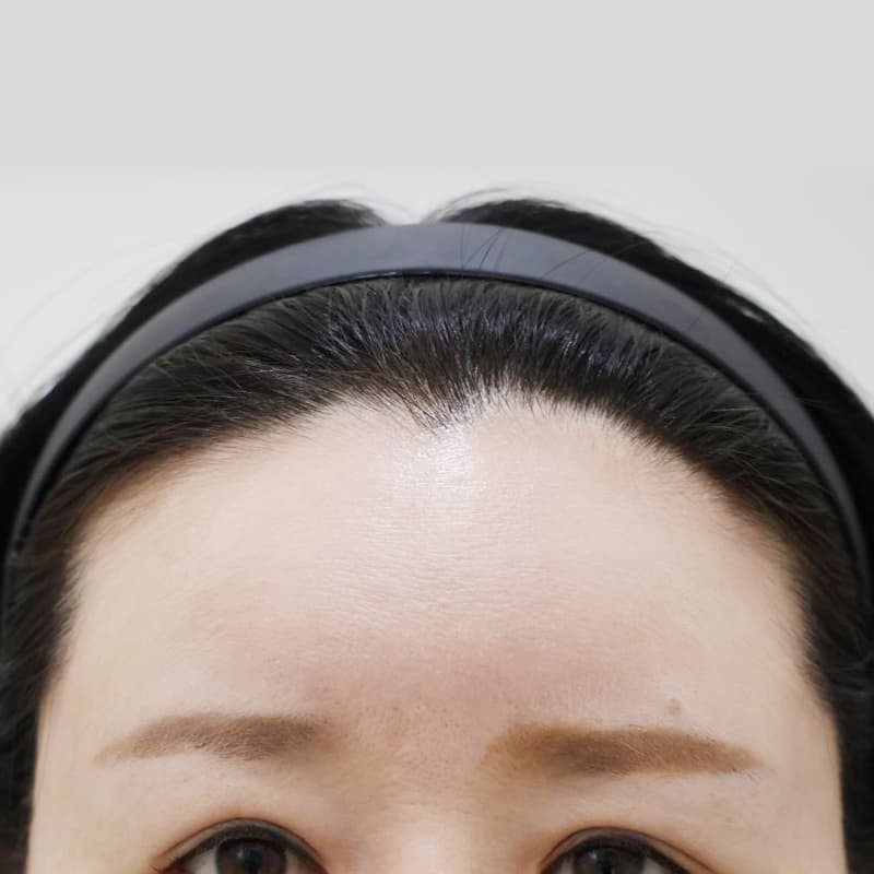 내시경 이마거상 before
