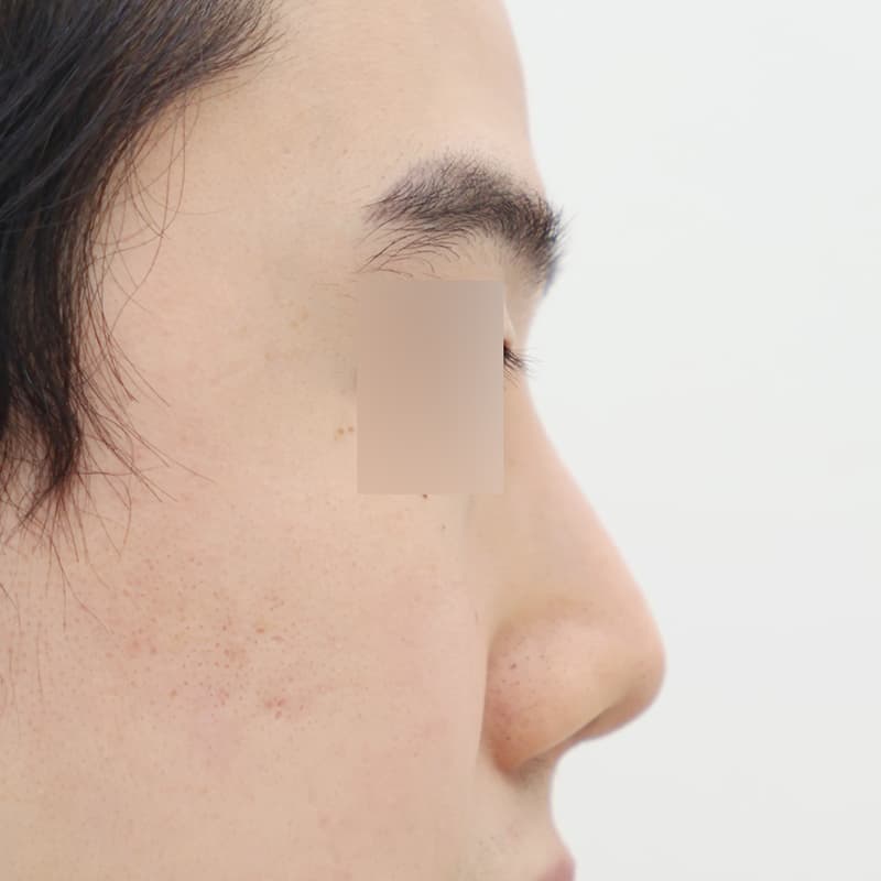 코재수술 before