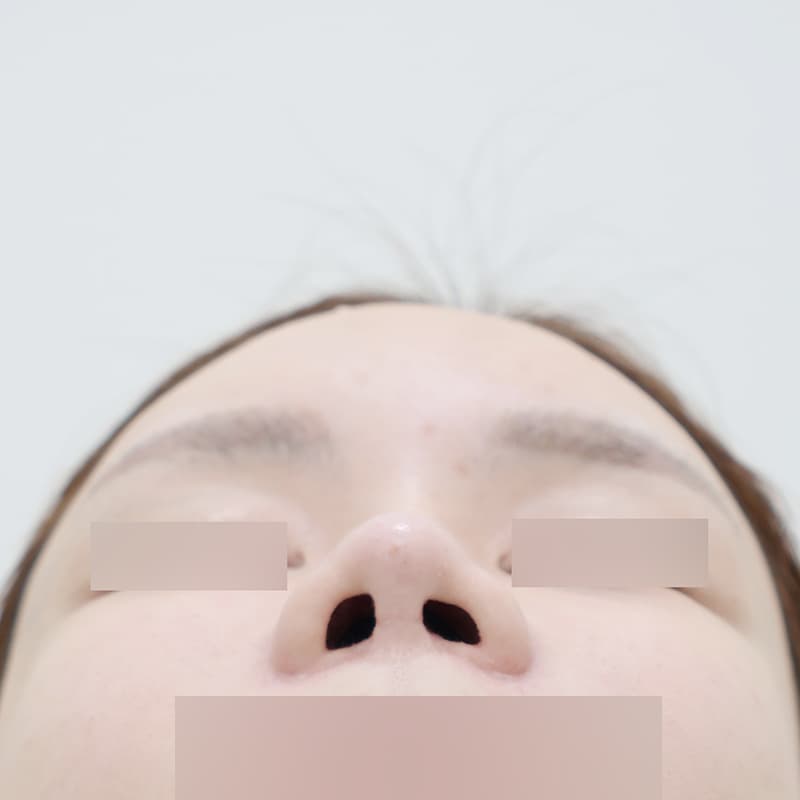 코재수술 before