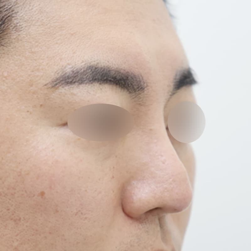 코재수술 before