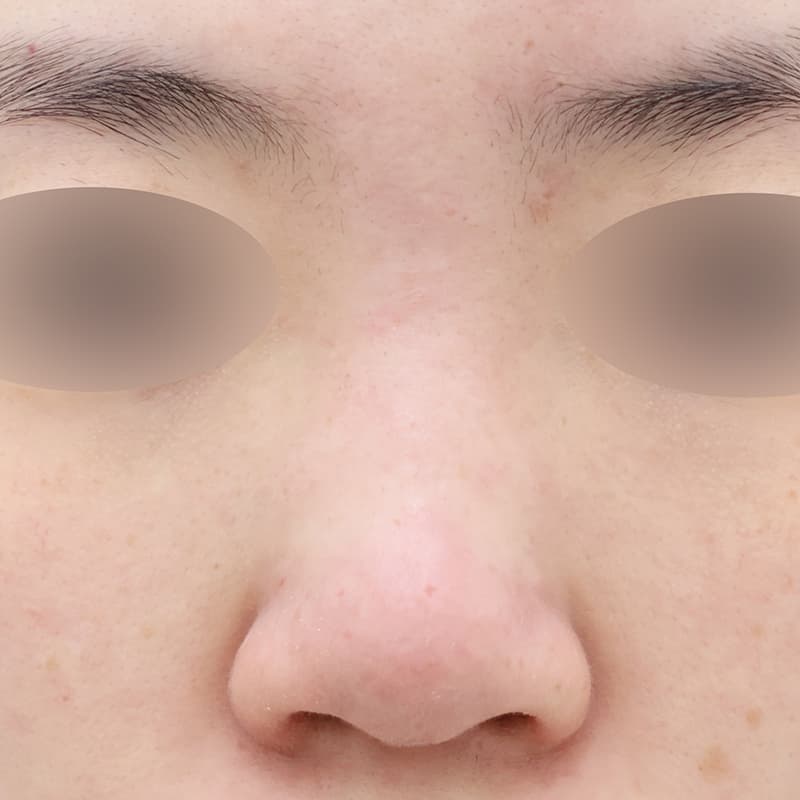 코성형 before