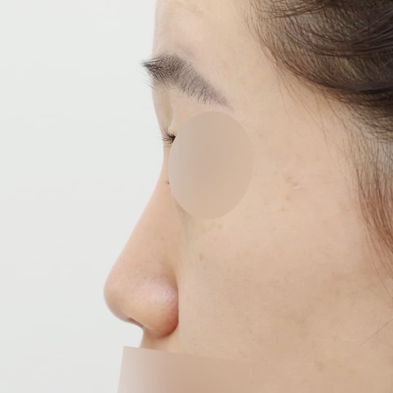 코재수술 before