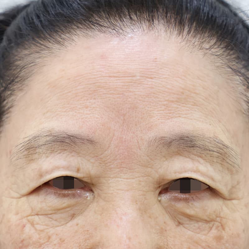 하안검 before