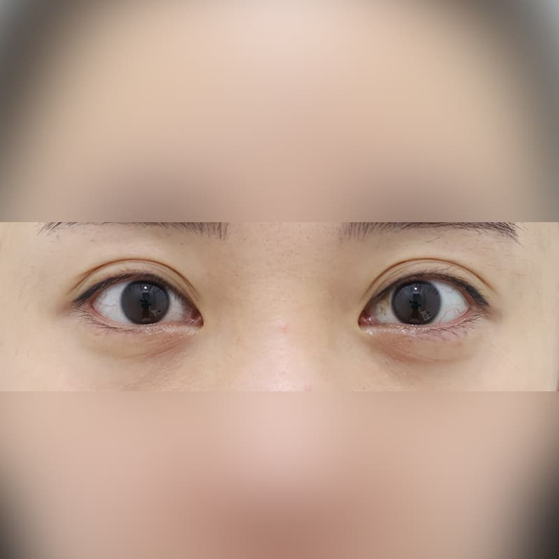 쌍꺼풀 before