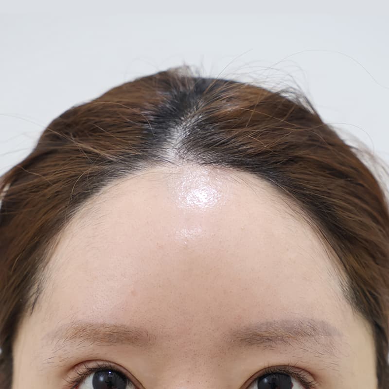 이마축소+이마거상 before