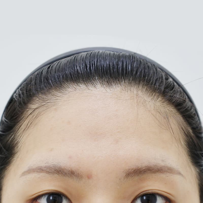내시경 이마거상 before