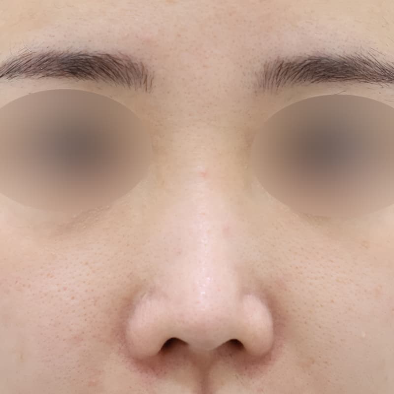 코재수술2 before