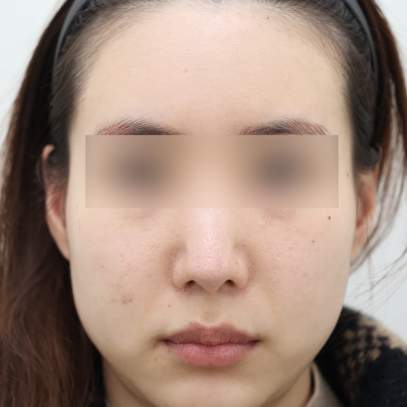 귀필러 6cc before