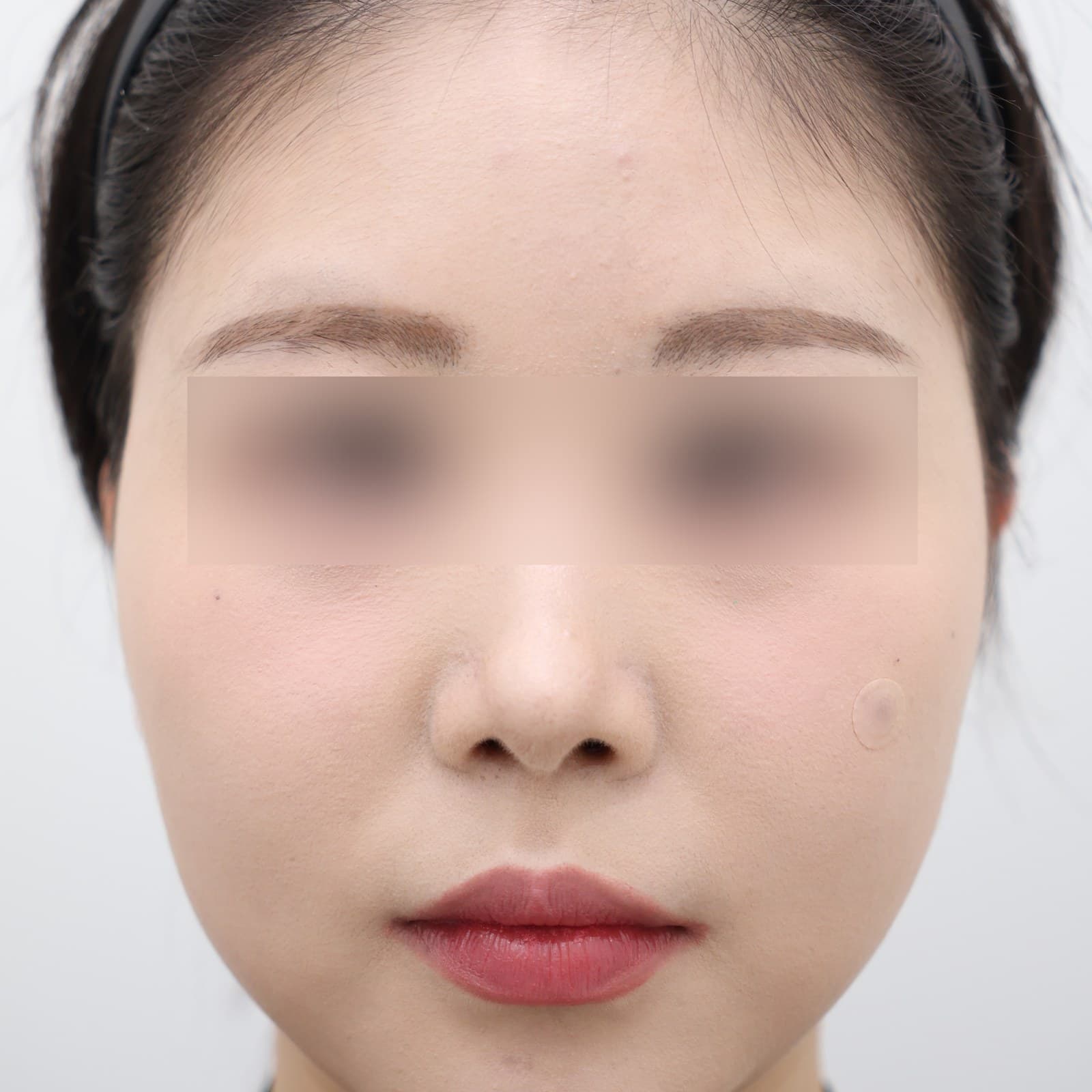 귀필러 6cc before