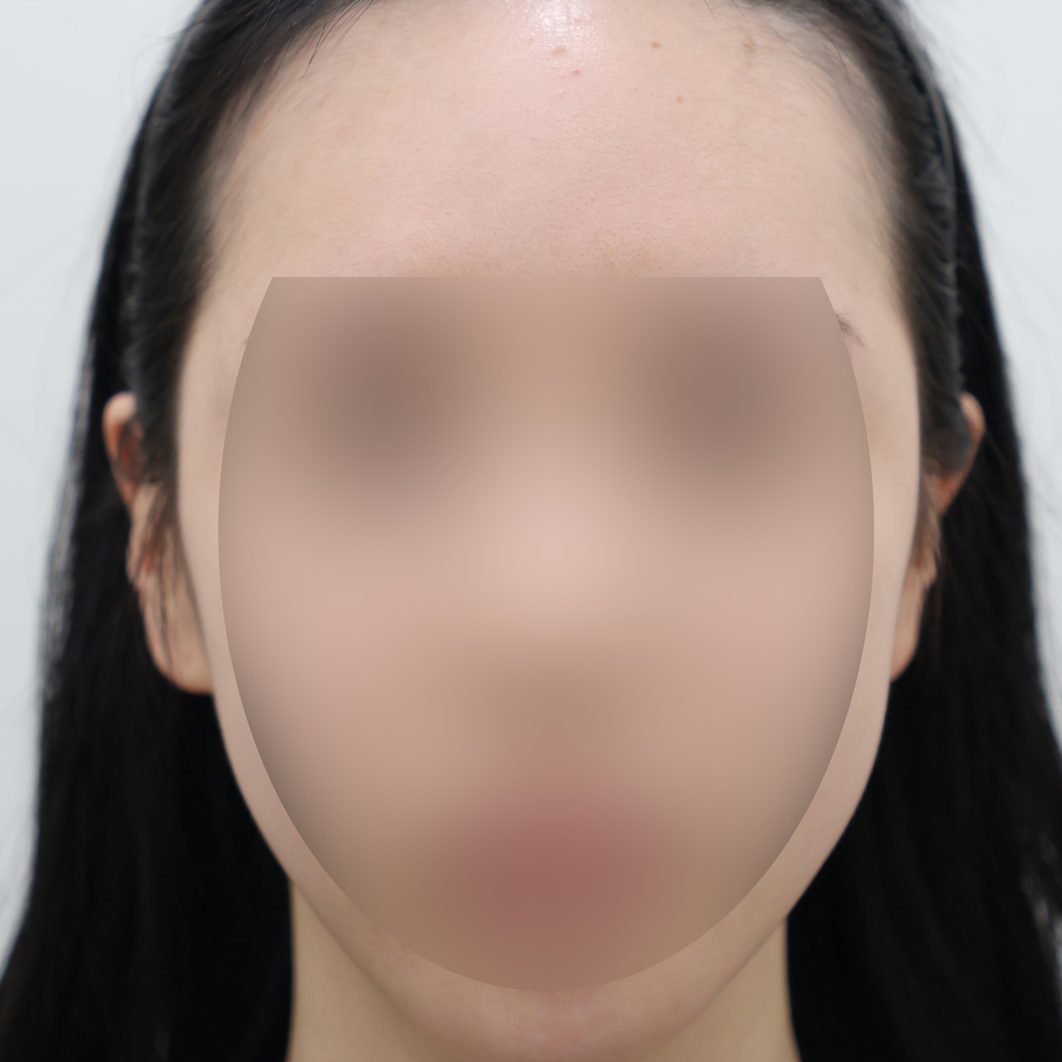 귀필러 5cc before