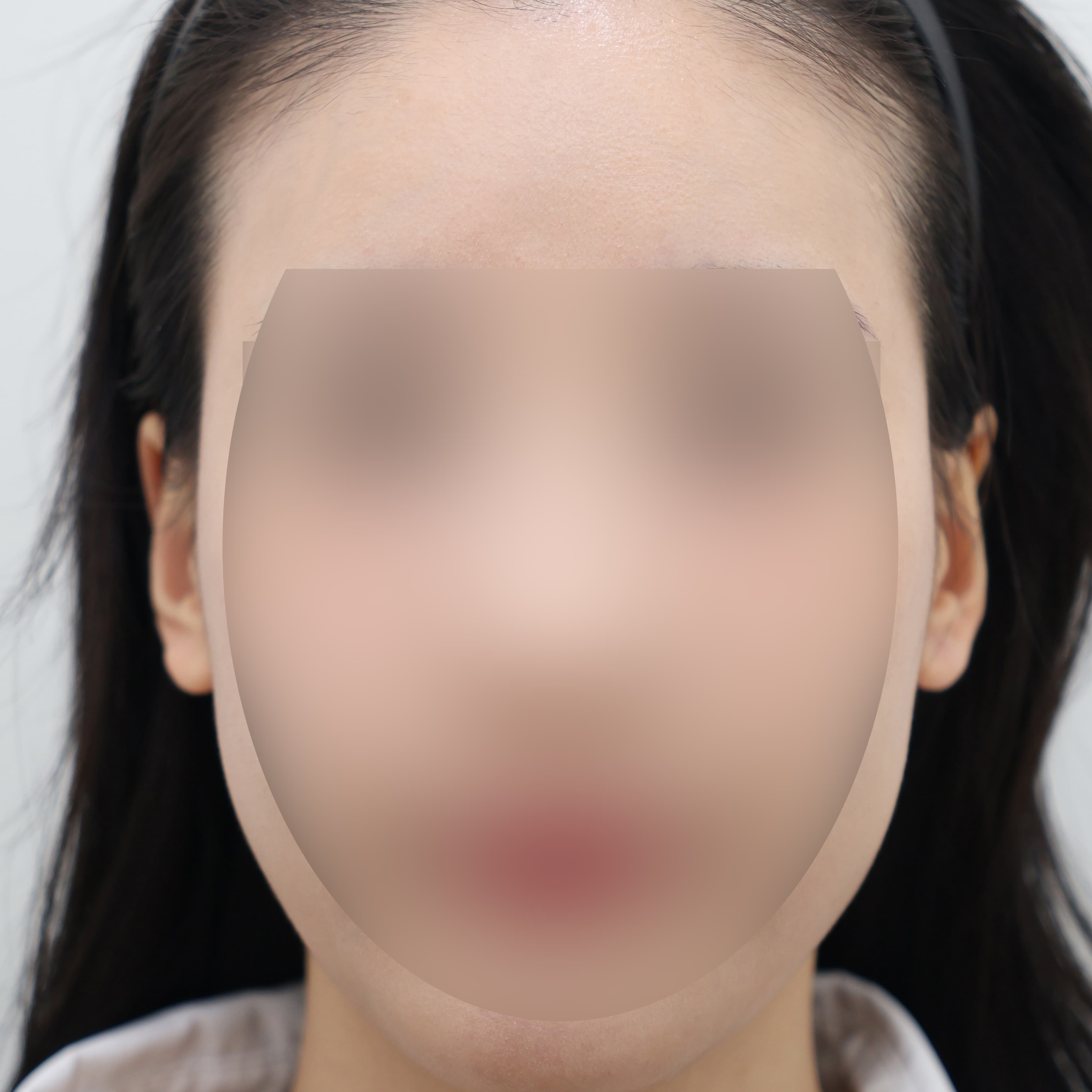 귀필러 7cc before