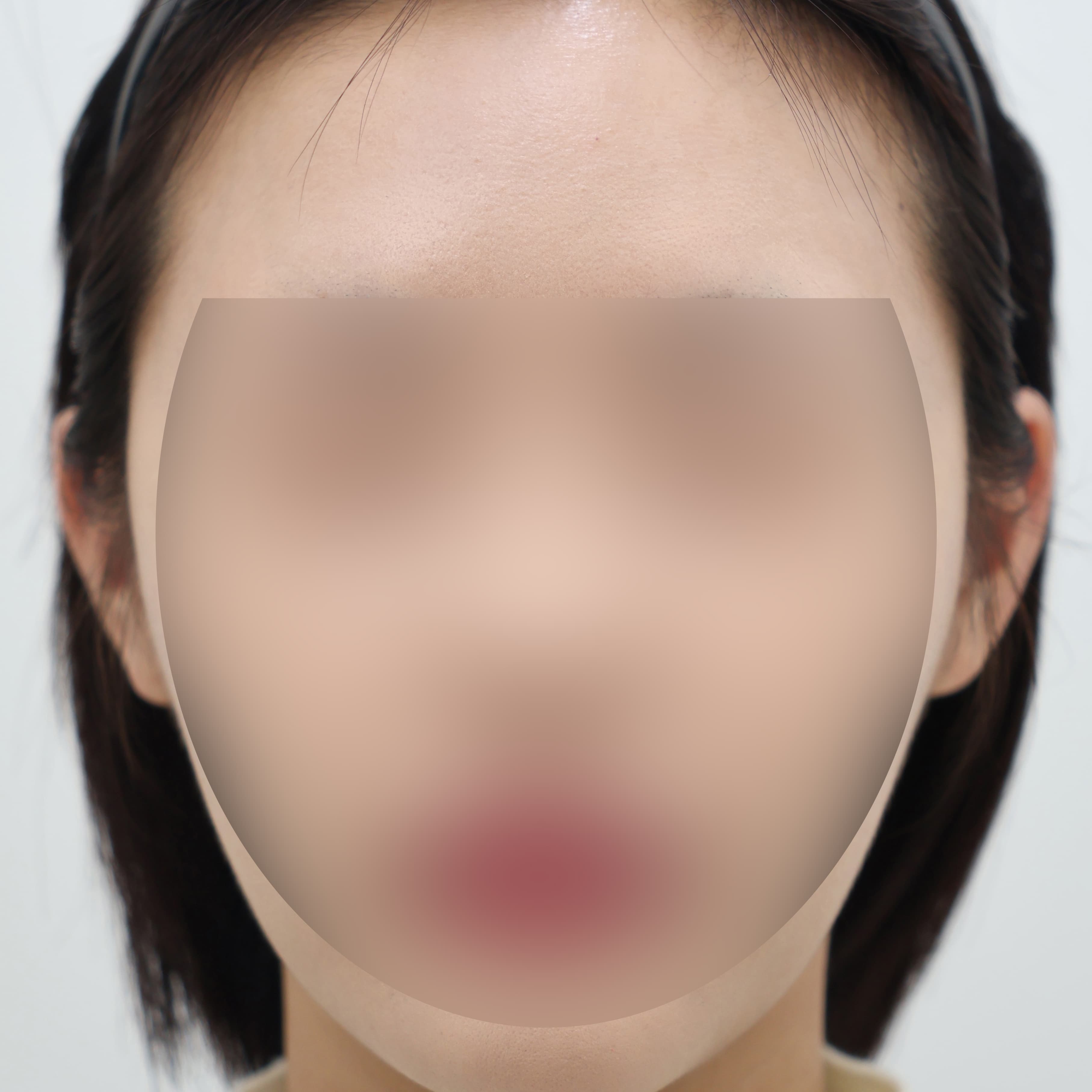 귀필러 6cc before