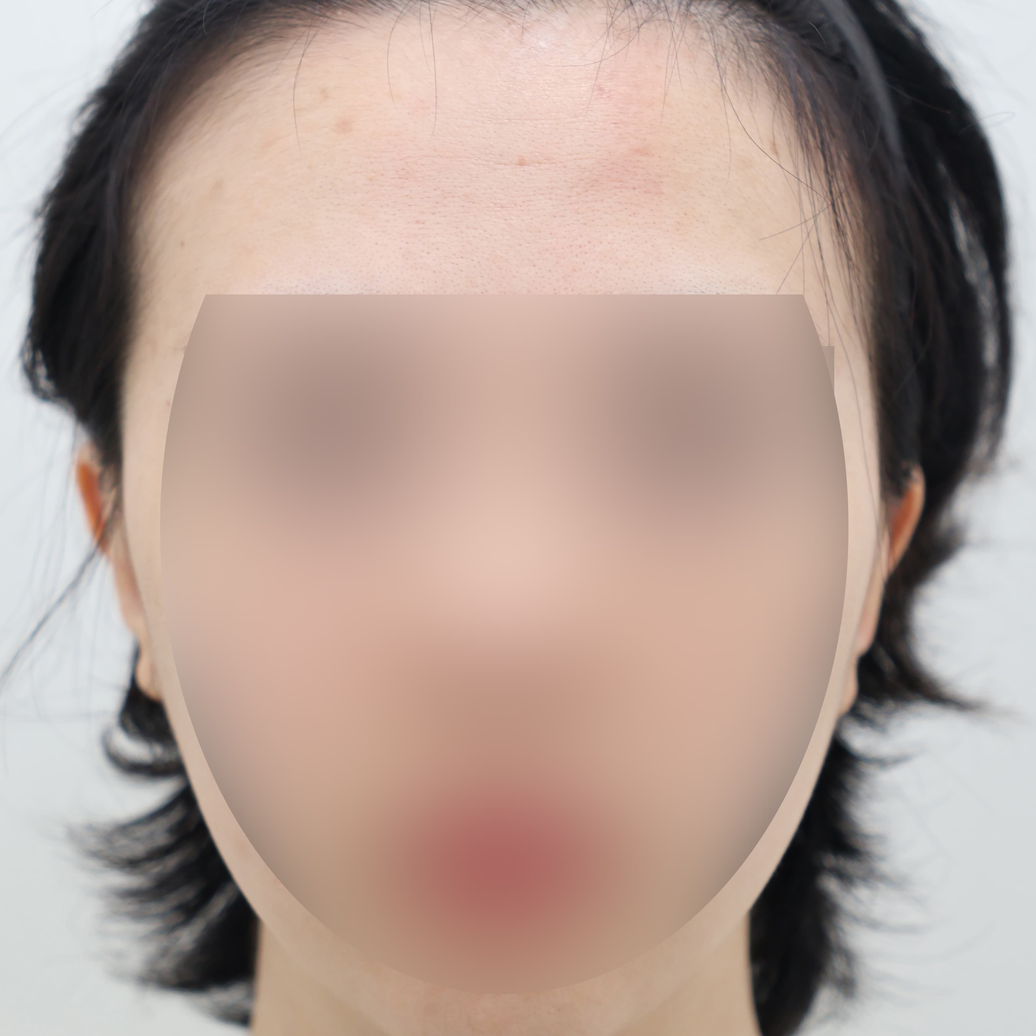 귀필러 8cc before