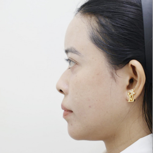 Revision Rhinoplasty with Autologous Rib Cartilage before